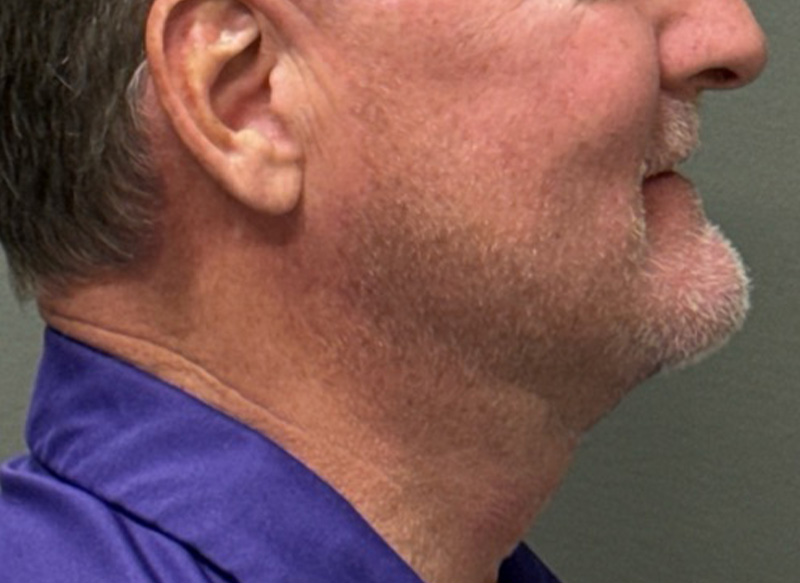 NECK LIFT Before & After Gallery - Patient 835979 - Image 2