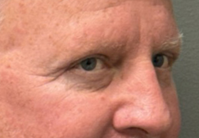 BLEPHAROPLASTY Before & After Gallery - Patient 142983 - Image 4