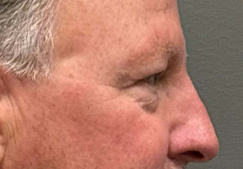 BLEPHAROPLASTY Before & After Gallery - Patient 142983 - Image 5