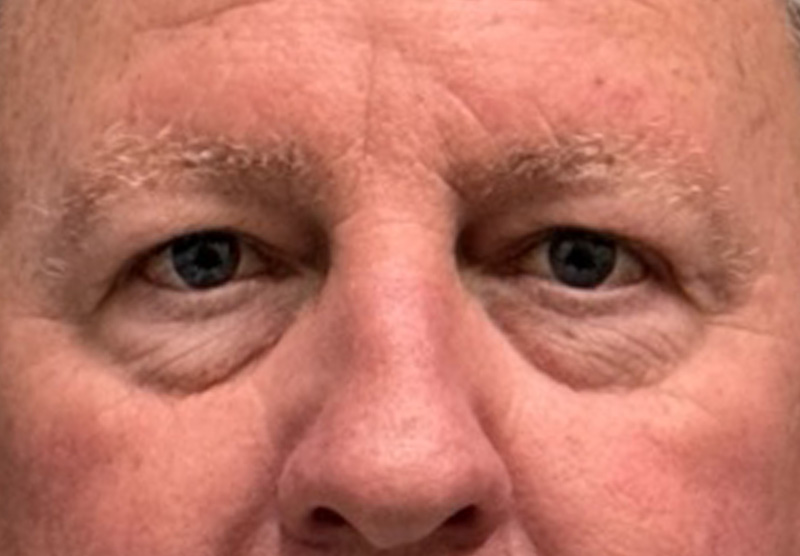 BLEPHAROPLASTY Before & After Gallery - Patient 142983 - Image 1