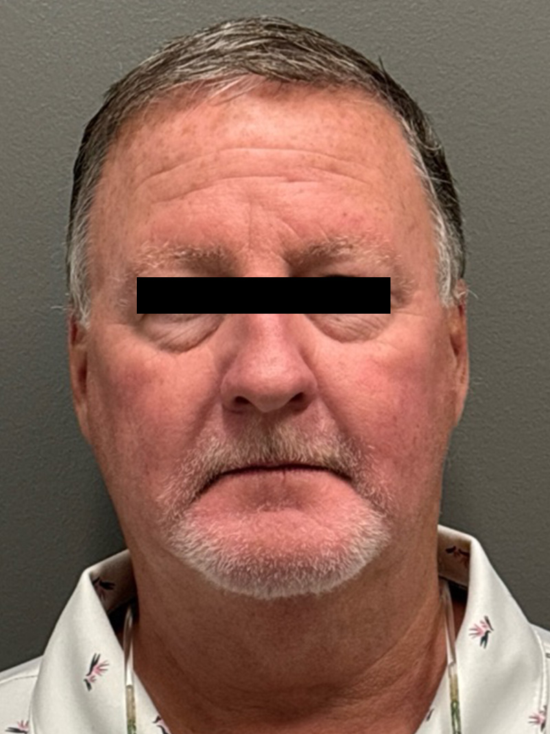 FAT GRAFTING Before & After Gallery - Patient 304195 - Image 1