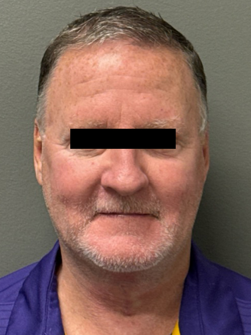 FAT GRAFTING Before & After Gallery - Patient 304195 - Image 2