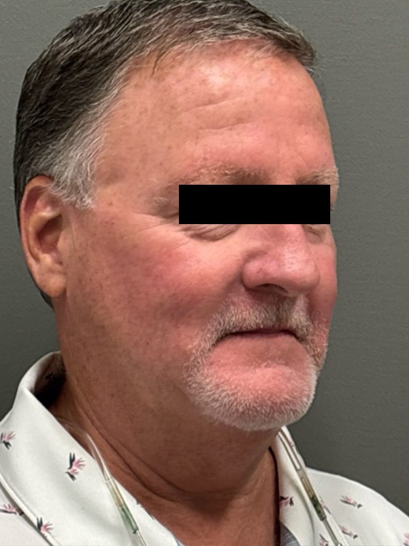 FAT GRAFTING Before & After Gallery - Patient 304195 - Image 3