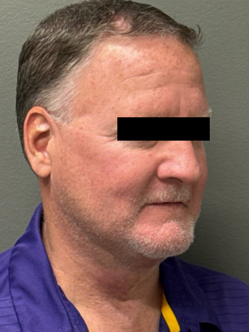 FAT GRAFTING Before & After Gallery - Patient 304195 - Image 4