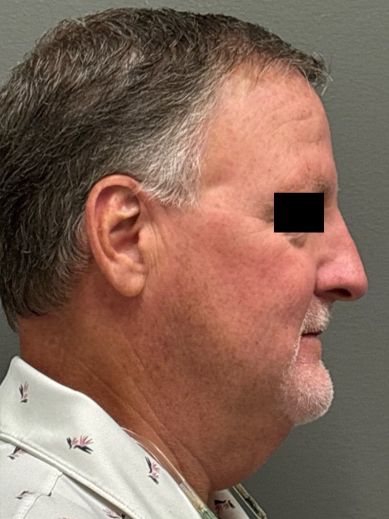 FAT GRAFTING Before & After Gallery - Patient 304195 - Image 5