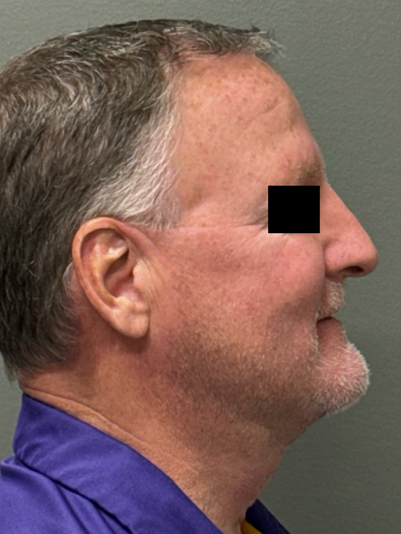 FAT GRAFTING Before & After Gallery - Patient 304195 - Image 6