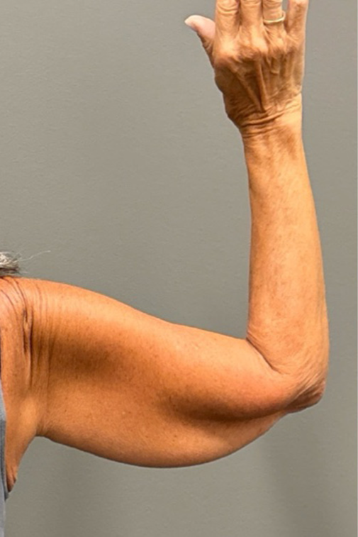 ARM LIFT Before & After Gallery - Patient 906005 - Image 1