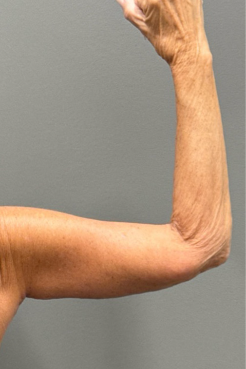 ARM LIFT Before & After Gallery - Patient 906005 - Image 2
