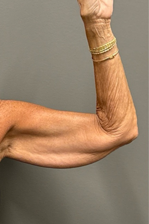 ARM LIFT Before & After Gallery - Patient 906005 - Image 3