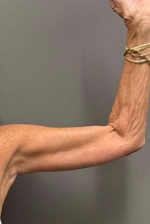 ARM LIFT Before & After Gallery - Patient 906005 - Image 4