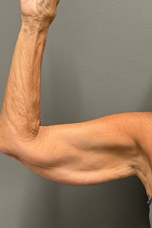 ARM LIFT Before & After Gallery - Patient 906005 - Image 5