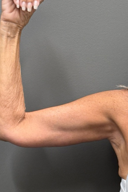 ARM LIFT Before & After Gallery - Patient 906005 - Image 6