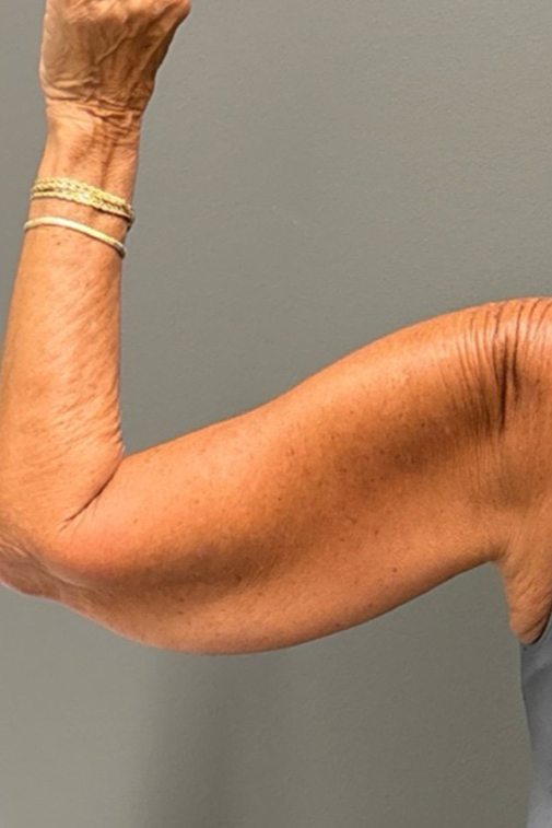 ARM LIFT Before & After Gallery - Patient 906005 - Image 7