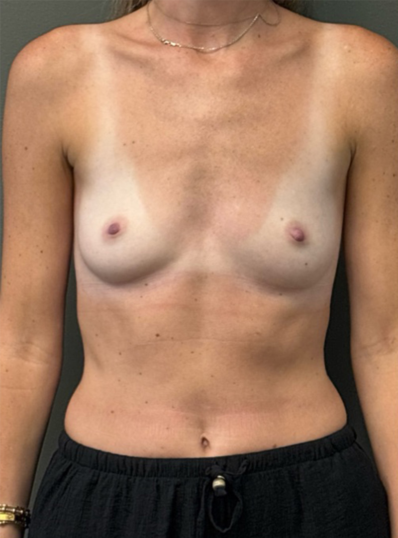 BREAST AUGMENTATION Before & After Gallery - Patient 415900 - Image 1