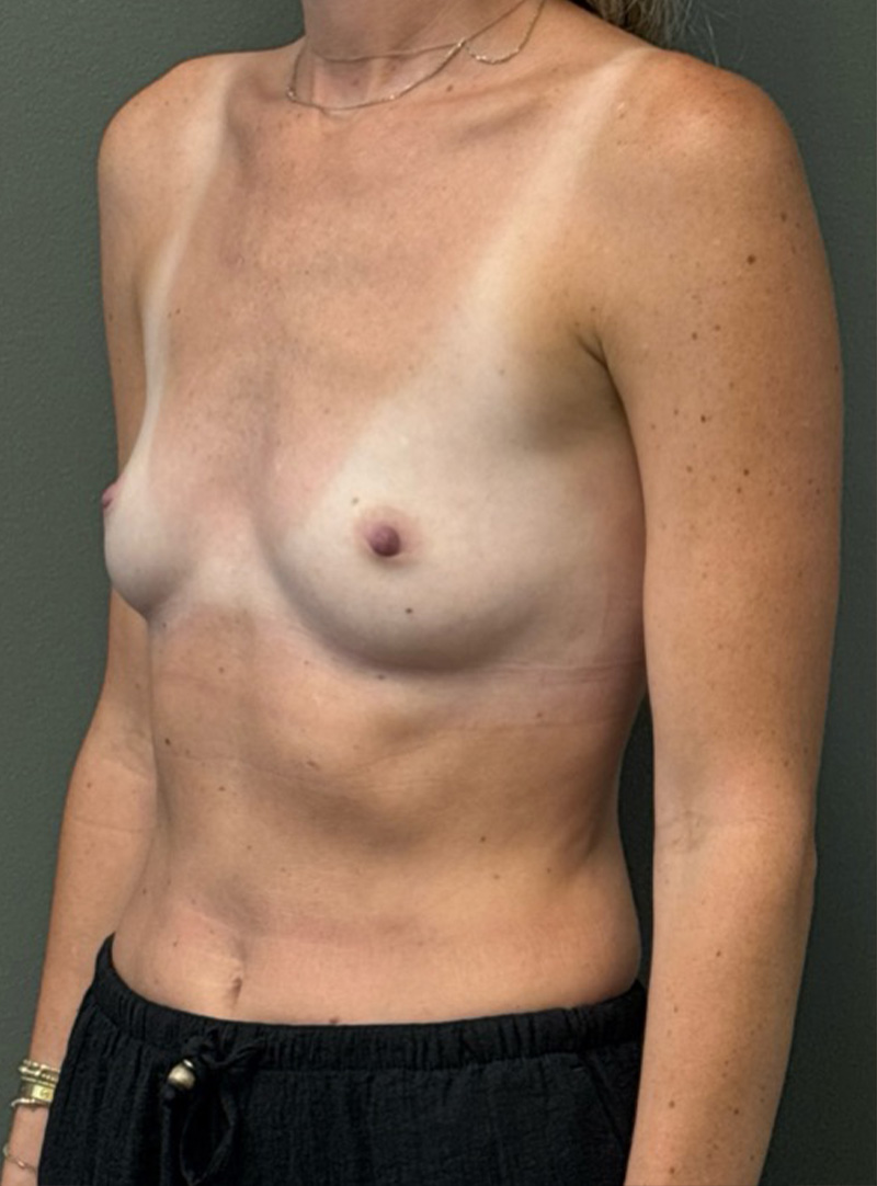 BREAST AUGMENTATION Before & After Gallery - Patient 415900 - Image 3