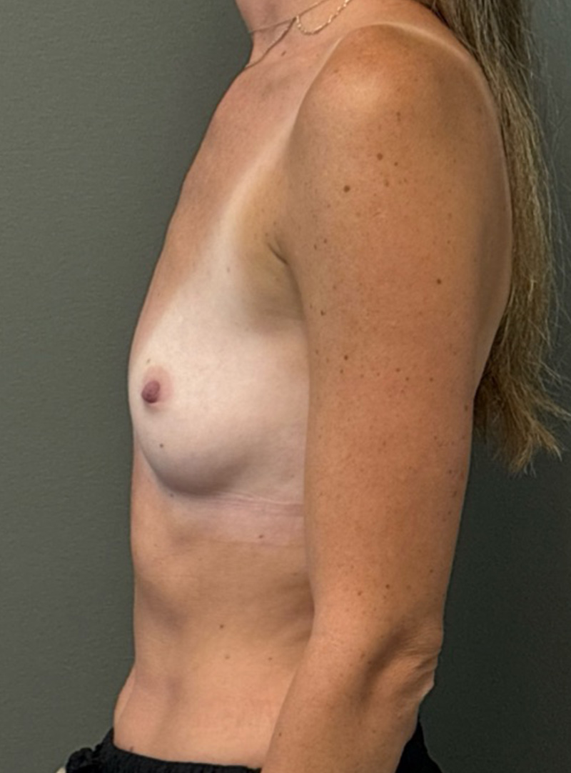 BREAST AUGMENTATION Before & After Gallery - Patient 415900 - Image 5