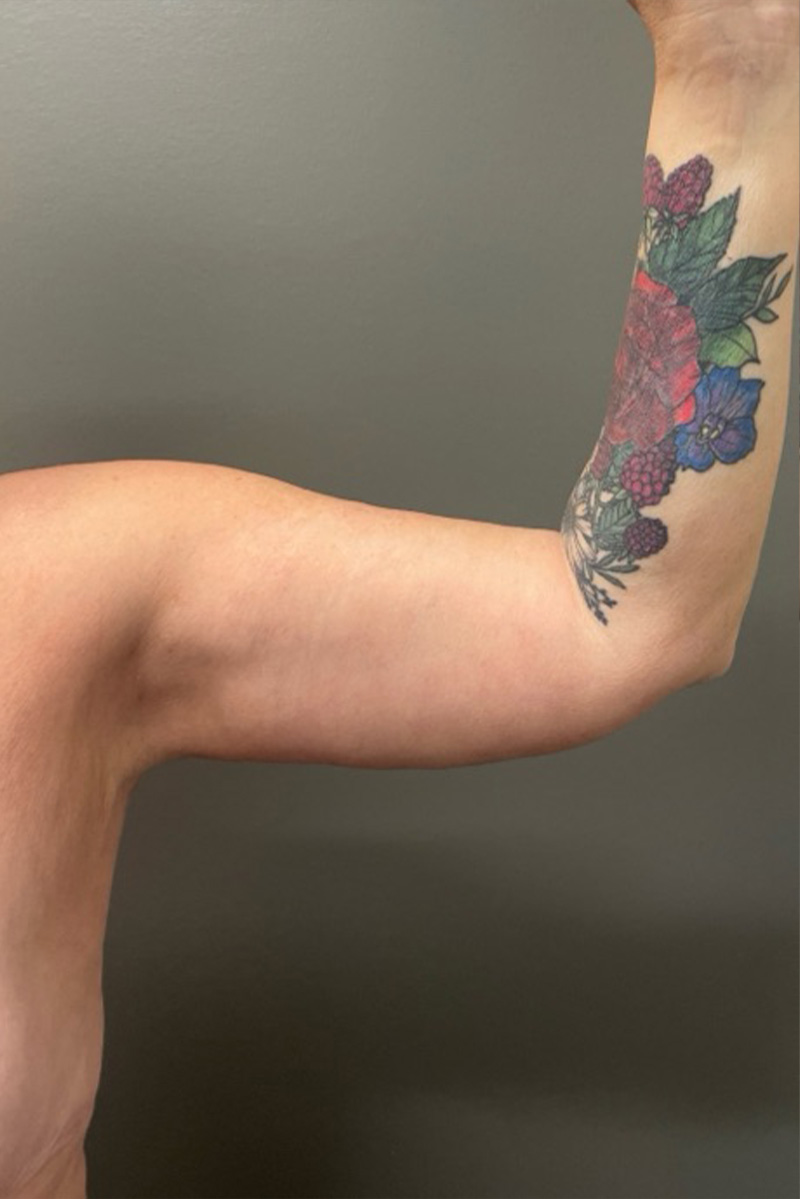 ARM LIFT Before & After Gallery - Patient 795690 - Image 2