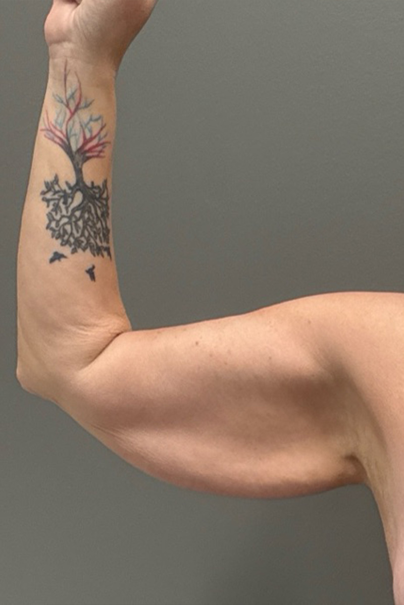 ARM LIFT Before & After Gallery - Patient 795690 - Image 3