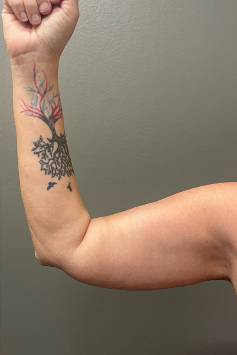 ARM LIFT Before & After Gallery - Patient 795690 - Image 4