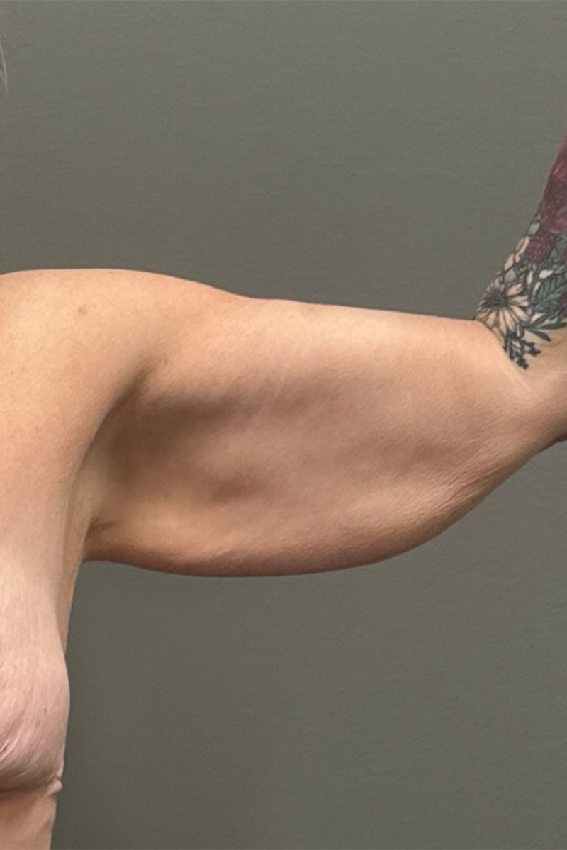ARM LIFT Before & After Gallery - Patient 795690 - Image 1