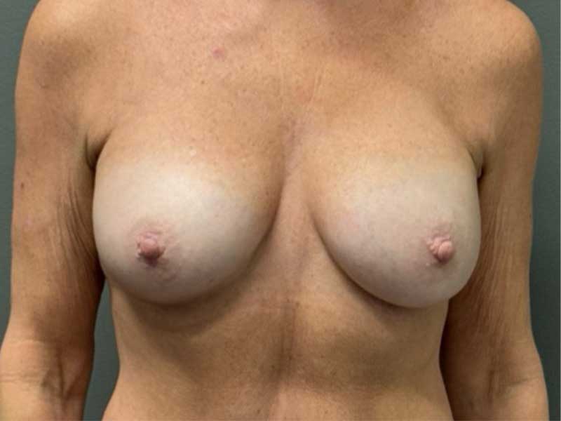 BREAST AUGMENTATION Before & After Gallery - Patient 204781 - Image 2