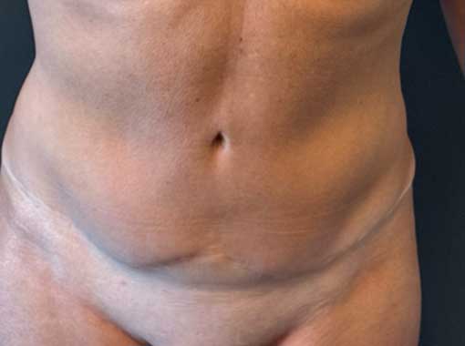 TUMMY TUCK Before & After Gallery - Patient 164629 - Image 1