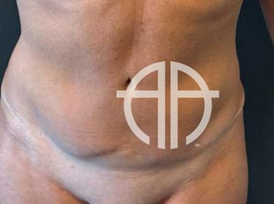 TUMMY TUCK Before & After Gallery - Patient 164629 - Image 1