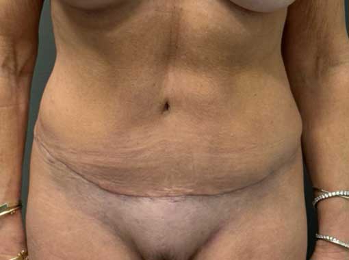 TUMMY TUCK Before & After Gallery - Patient 164629 - Image 2