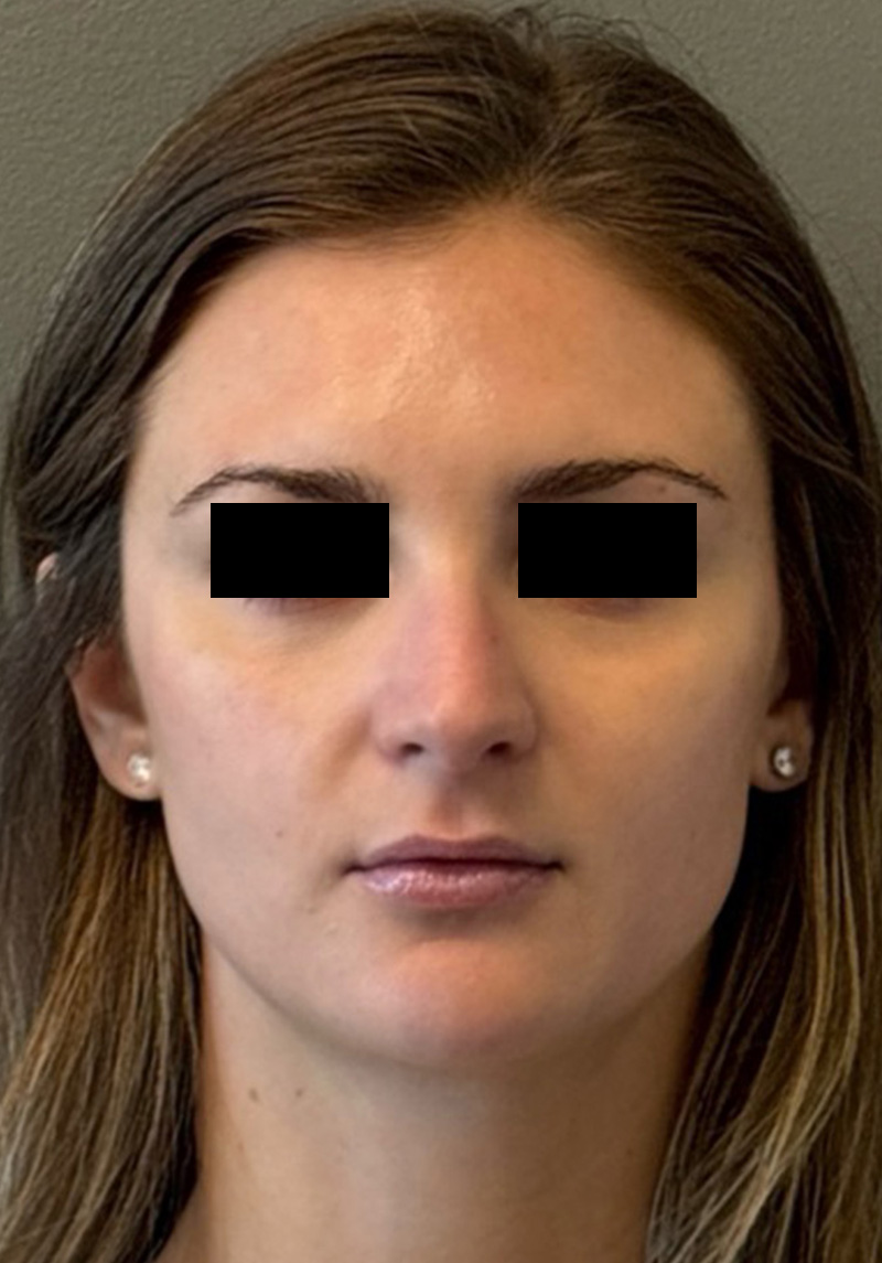 LIQUID RHINOPLASTY Before & After Gallery - Patient 106257 - Image 1
