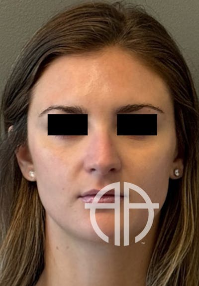 UNDEREYE FILLER Before & After Gallery - Patient 475406 - Image 1