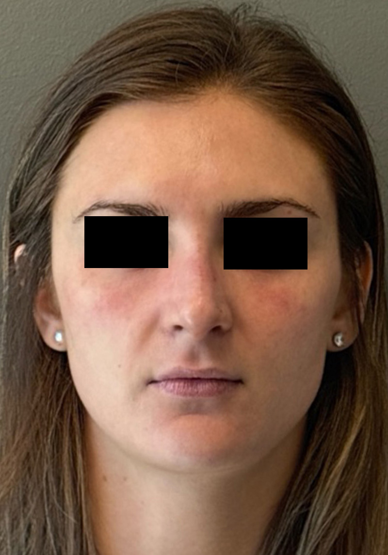 LIQUID RHINOPLASTY Before & After Gallery - Patient 106257 - Image 2