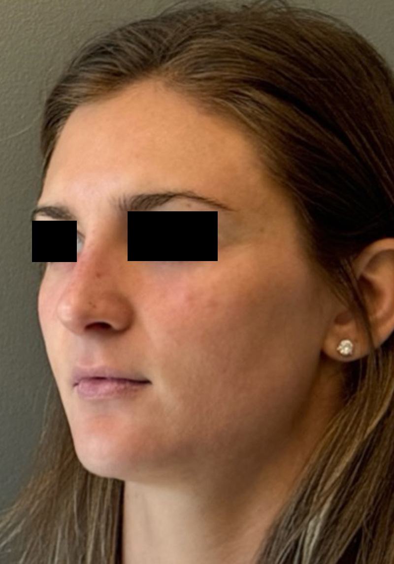 LIQUID RHINOPLASTY Before & After Gallery - Patient 106257 - Image 4