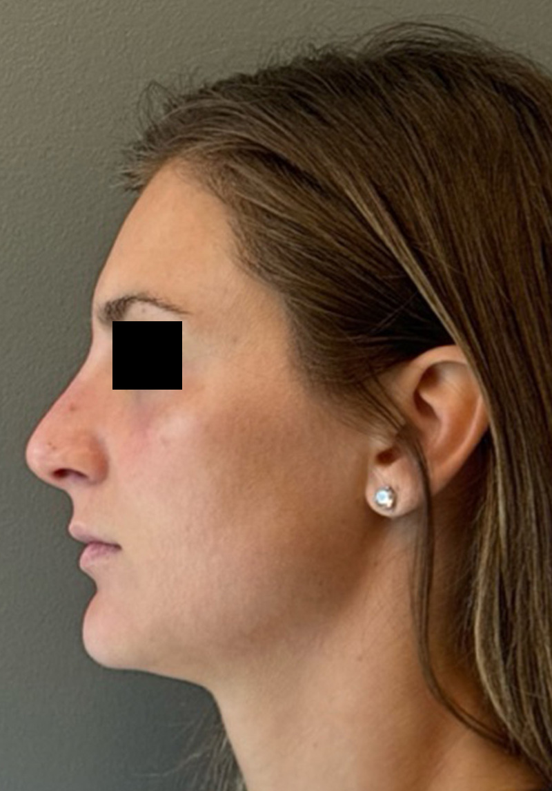 LIQUID RHINOPLASTY Before & After Gallery - Patient 106257 - Image 6