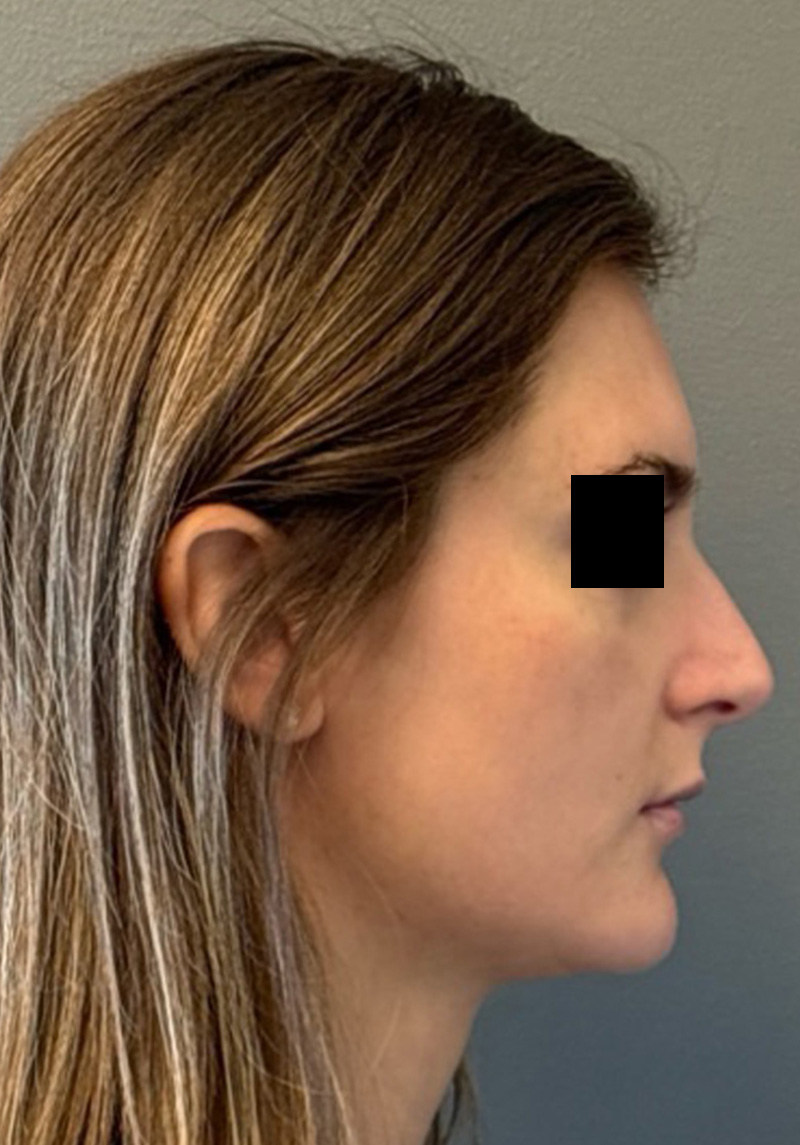 LIQUID RHINOPLASTY Before & After Gallery - Patient 106257 - Image 7