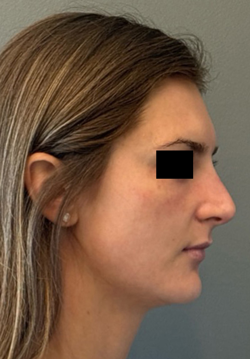 LIQUID RHINOPLASTY Before & After Gallery - Patient 106257 - Image 8