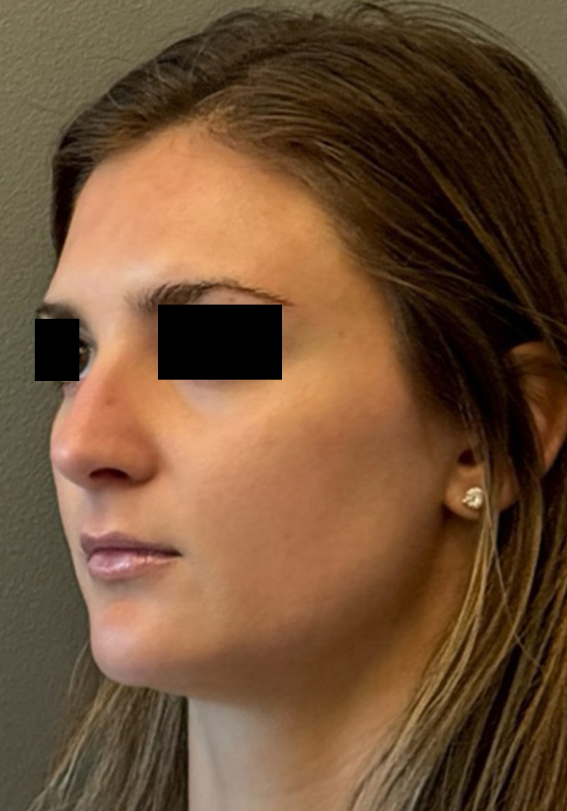 LIQUID RHINOPLASTY Before & After Gallery - Patient 106257 - Image 3
