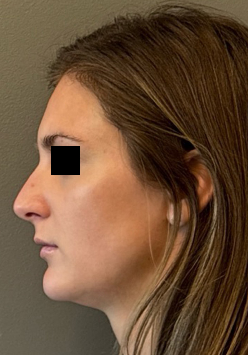 LIQUID RHINOPLASTY Before & After Gallery - Patient 106257 - Image 5