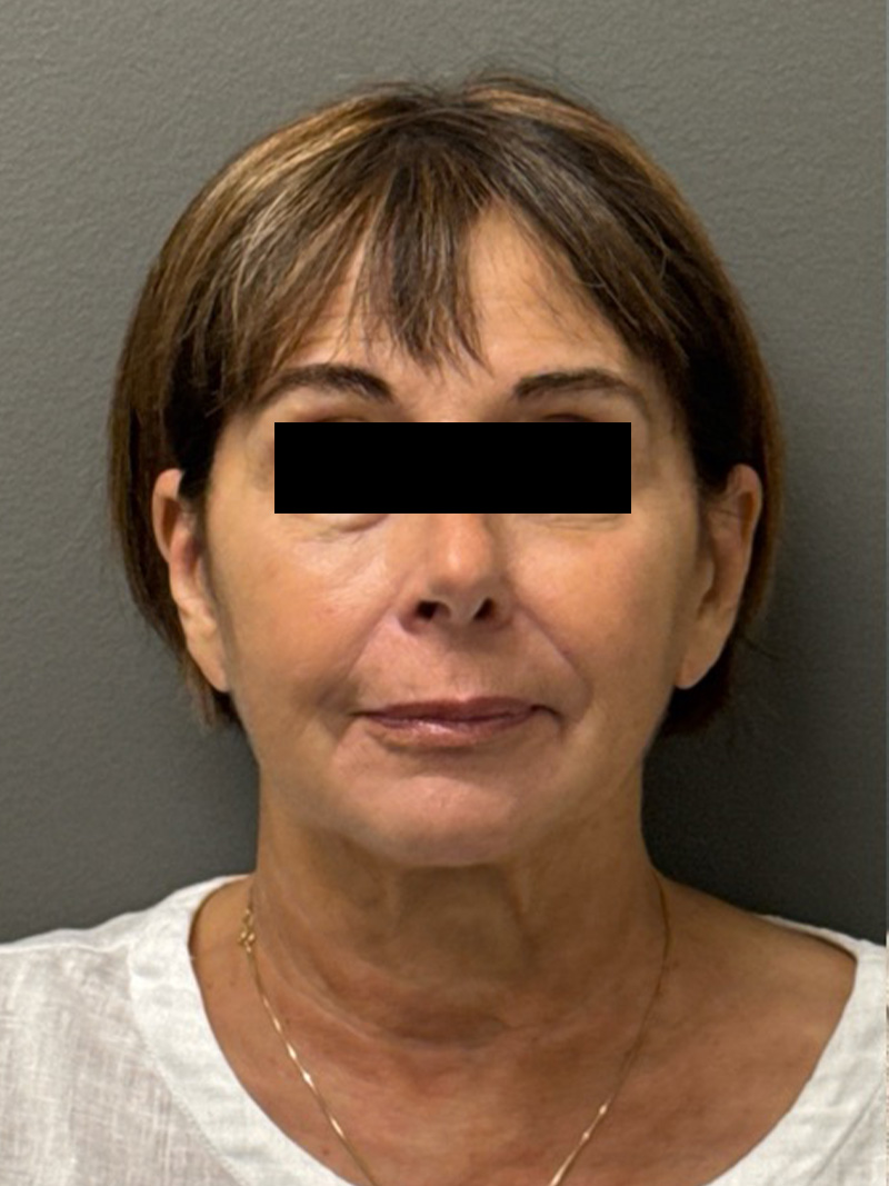 FAT GRAFTING Before & After Gallery - Patient 139959 - Image 1