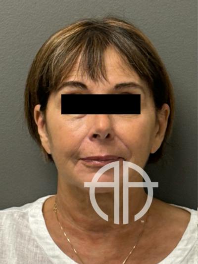 FACELIFT Before & After Gallery - Patient 553322 - Image 1