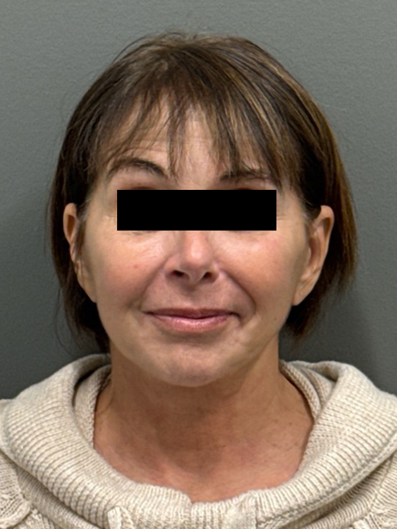 FAT GRAFTING Before & After Gallery - Patient 139959 - Image 2