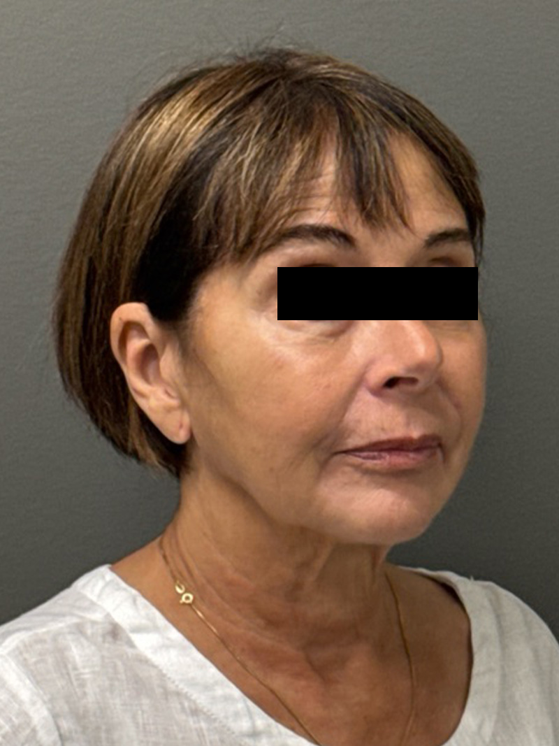 FACELIFT Before & After Gallery - Patient 553322 - Image 3