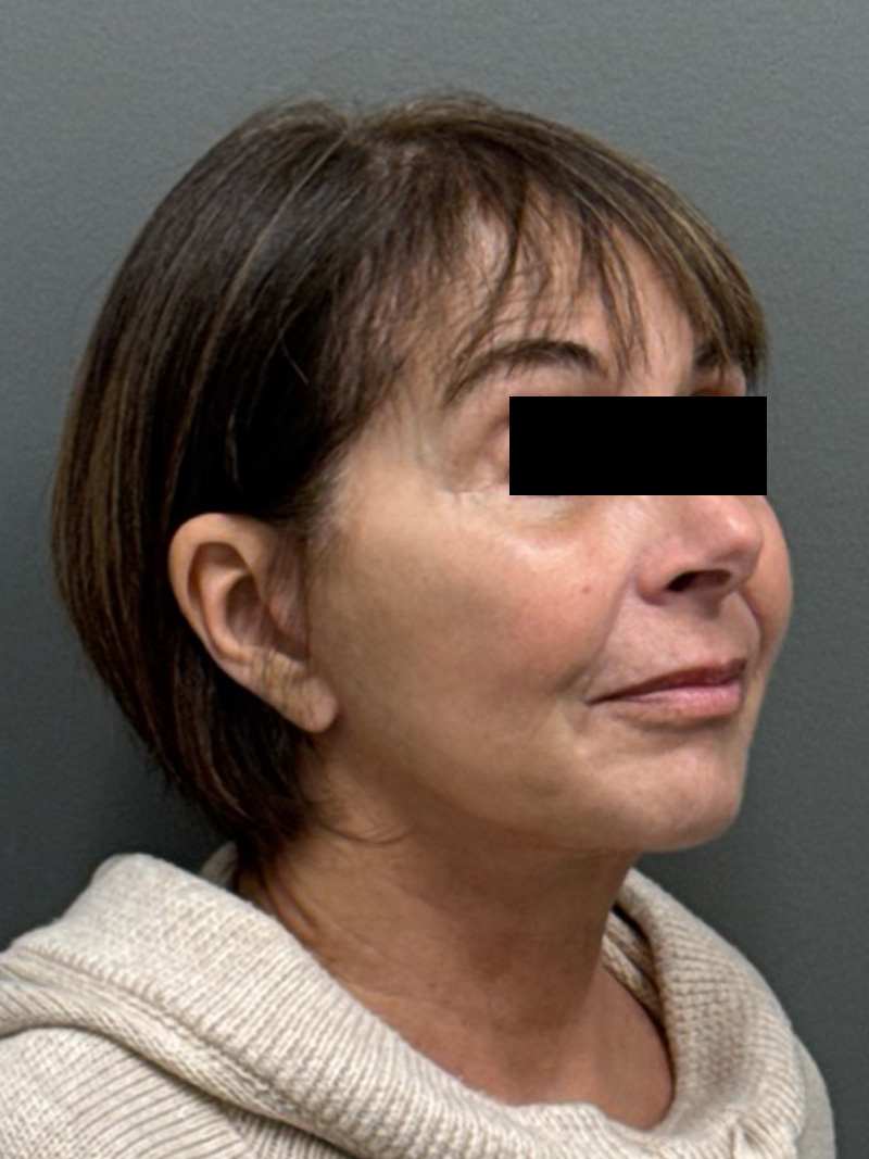 FACELIFT Before & After Gallery - Patient 553322 - Image 4