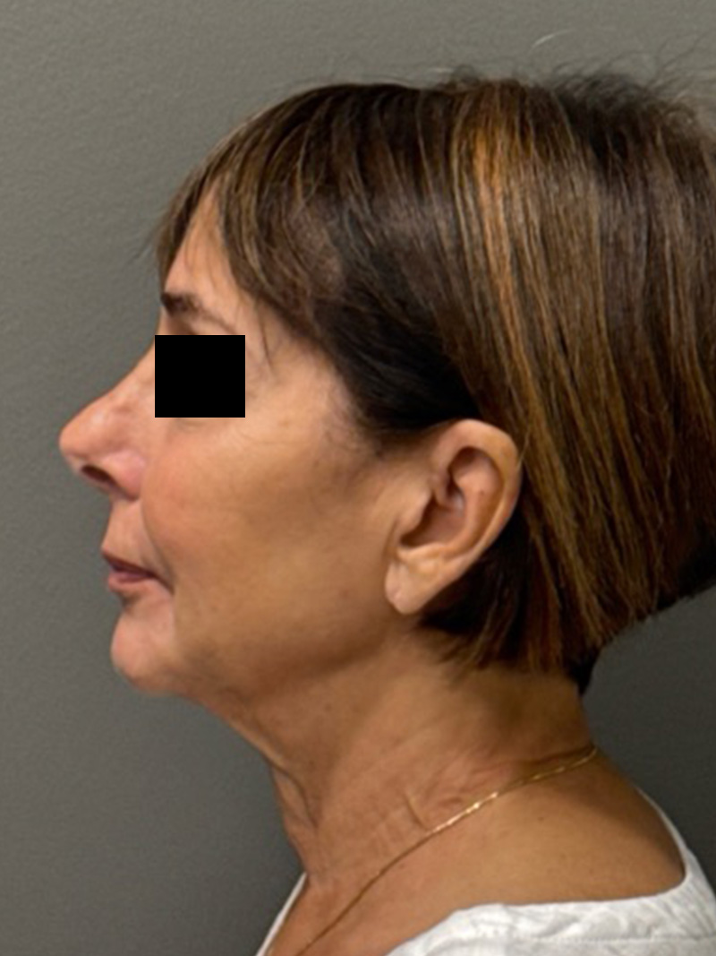 FACELIFT Before & After Gallery - Patient 553322 - Image 5
