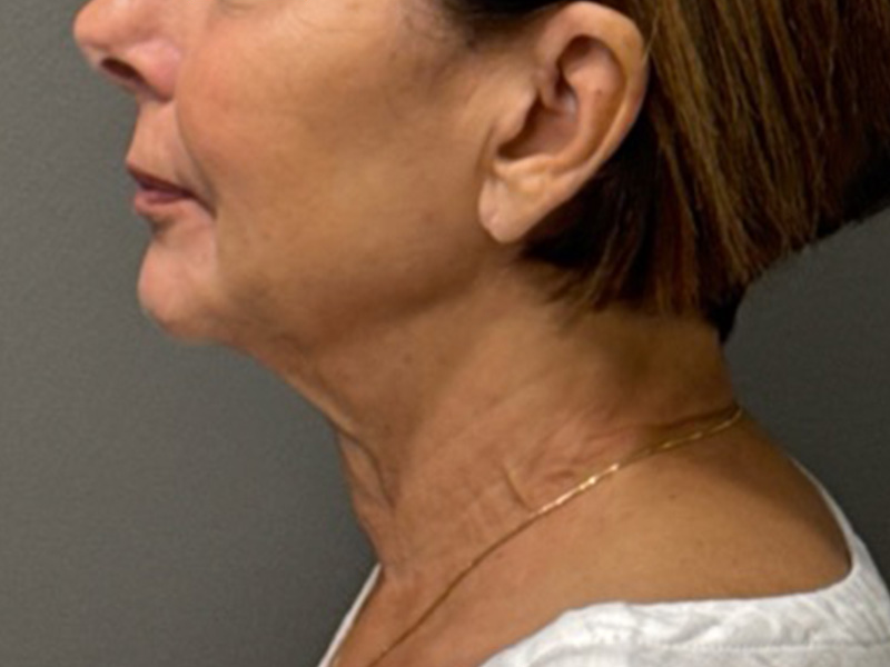 NECK LIFT Before & After Gallery - Patient 385603 - Image 1