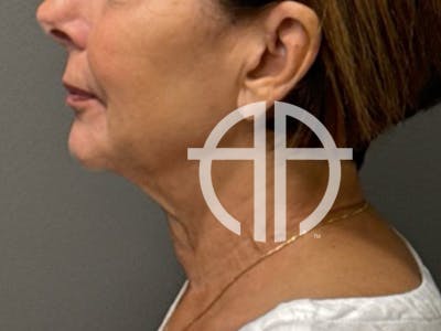 NECK LIFT Before & After Gallery - Patient 385603 - Image 1