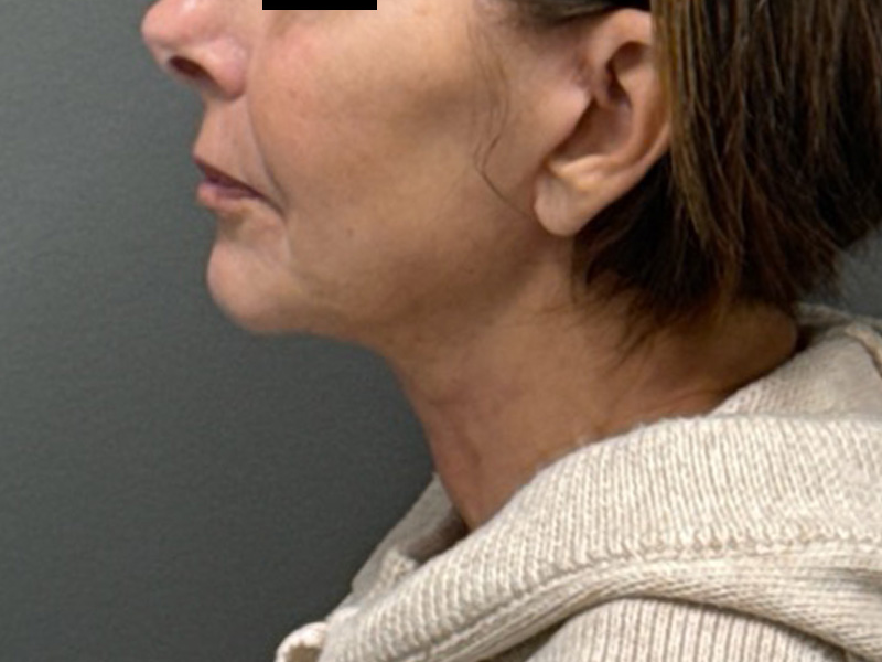 NECK LIFT Before & After Gallery - Patient 385603 - Image 2
