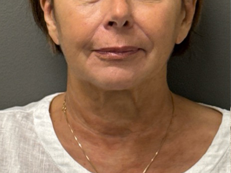 NECK LIFT Before & After Gallery - Patient 385603 - Image 5
