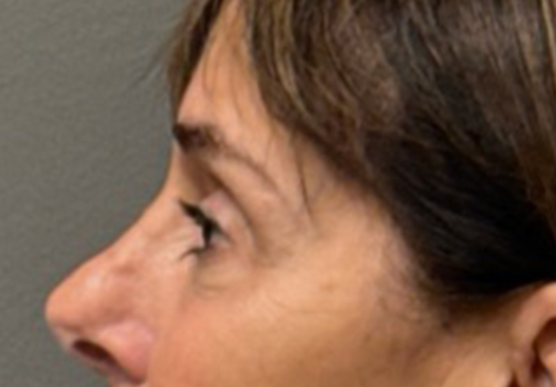 BLEPHAROPLASTY Before & After Gallery - Patient 122175 - Image 5