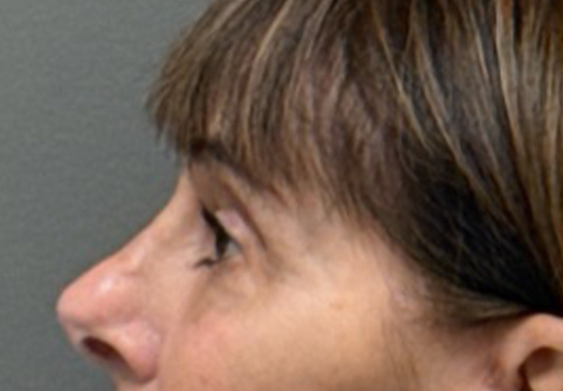 BLEPHAROPLASTY Before & After Gallery - Patient 122175 - Image 6