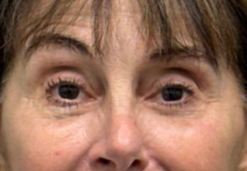 BLEPHAROPLASTY Before & After Gallery - Patient 122175 - Image 2